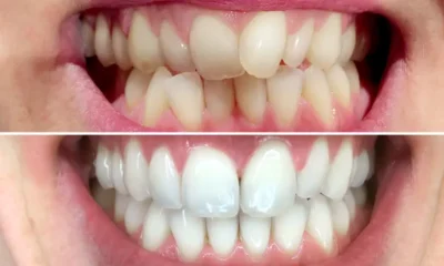 Tooth Discoloration