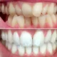 Tooth Discoloration