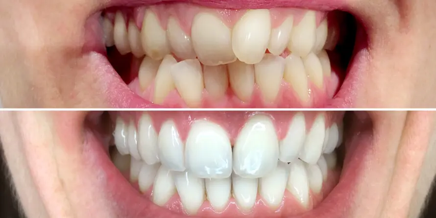 Tooth Discoloration